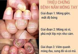 Mẹo vặt chữa nấm móng tay bằng tỏi như thế nào?